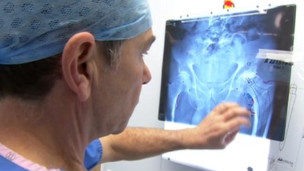 2012英國BBC:金屬髖骨關節置換失敗率偏高1