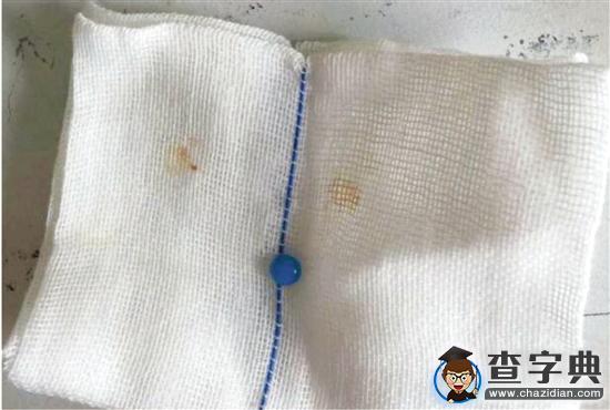 3歲寶寶耳朵疼了一夜 原來里面藏著一顆玻璃珠1