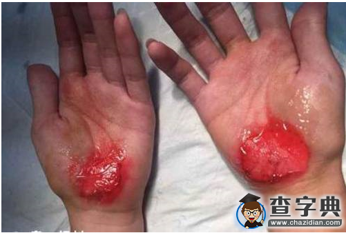 深圳一高中生遭體罰用手走路 雙手血肉模糊1